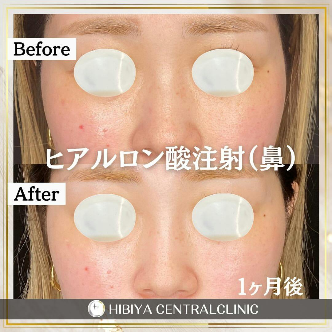 【女性・鼻】ヒアルロン酸注射_before_aftar