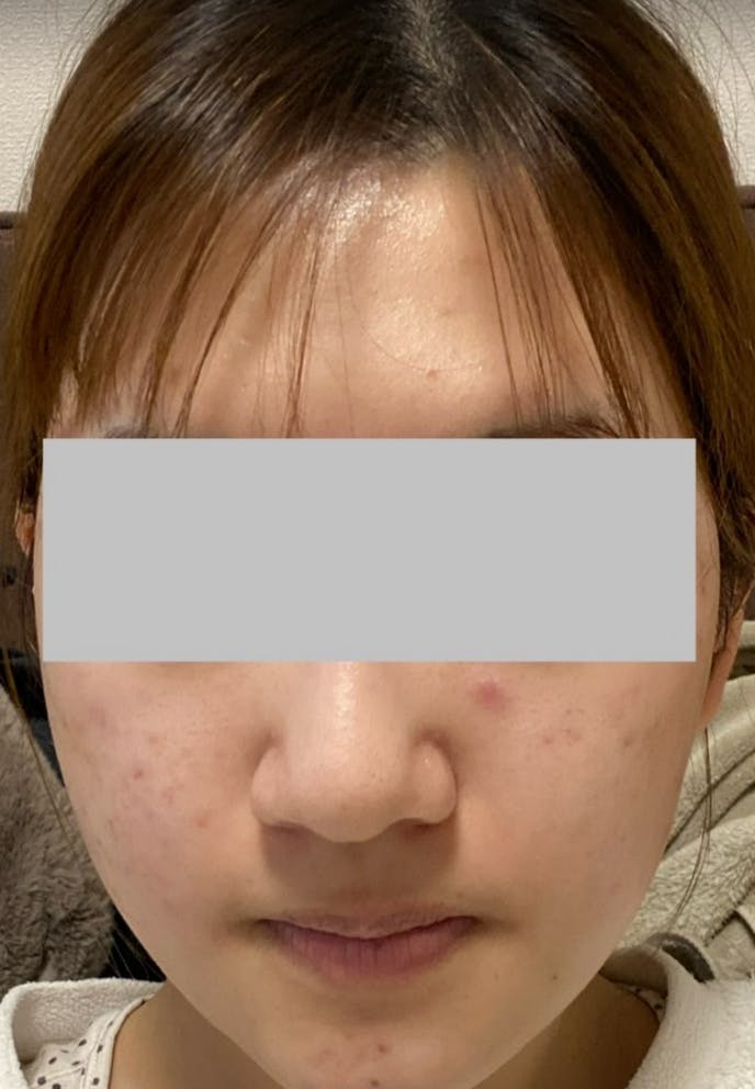 湘南美容クリニック 新宿本院でIPL光治療(フォトフェイシャル)・フォトフェイシャルステラM22・医療レーザー治療・ニキビ治療を受けたふぃーごさんの写真