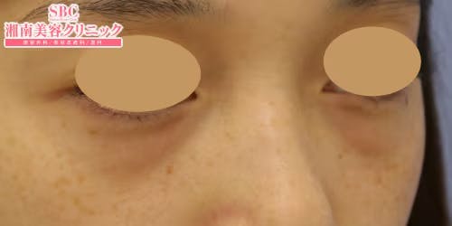 【女性・目元】目の下の切らないクマ・たるみ（ふくらみ）取り、ナチュラル脂肪注射コンデンスリッチ_before