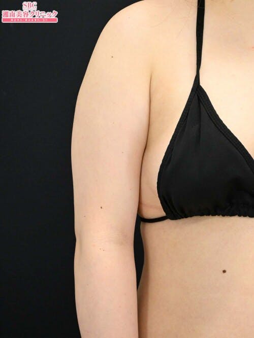 【20代女性・二の腕】クールスカルプティング(R)・ エリート（クルスカダブル） サクセンダ_before