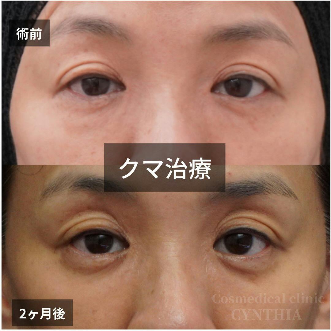 【50代女性・目元】目の下のクマ・たるみ取り_before_aftar