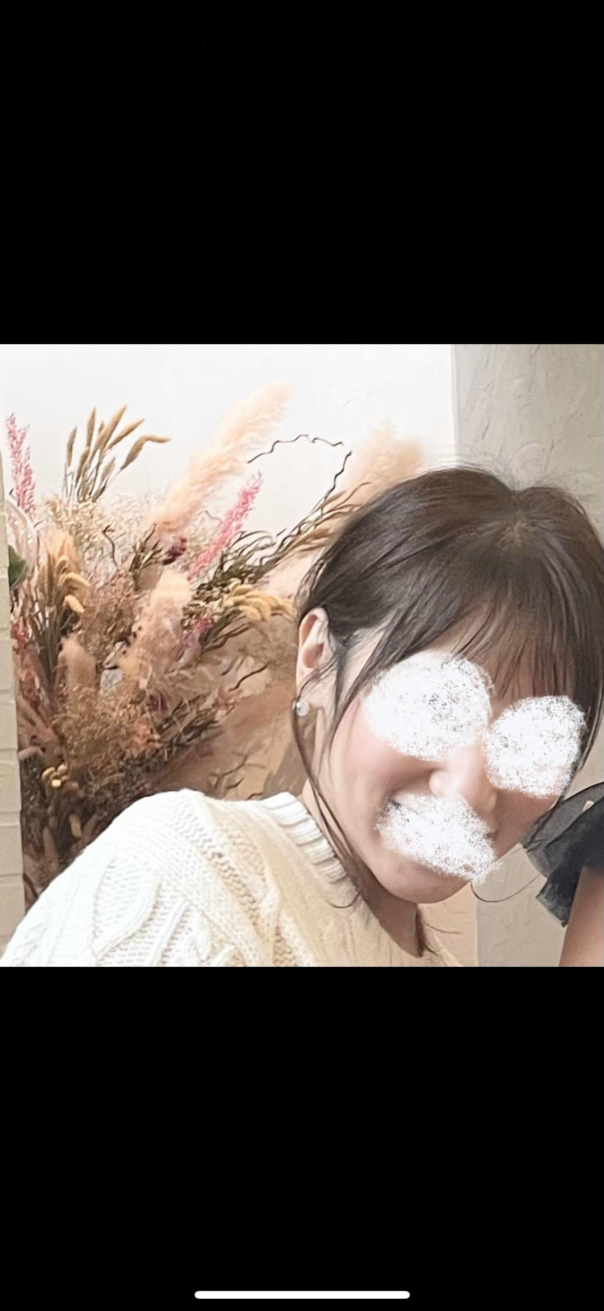 モーブビューティークリニック札幌大通(Mauve Beauty Clinic 札幌大通)で小鼻縮小・鼻翼縮小術・口角ボトックス注射・ボトックス注射(顎)・目尻ボトックス注射・眉間ボトックス注射・目の下ボトックス注射を受けたelleriさんの写真