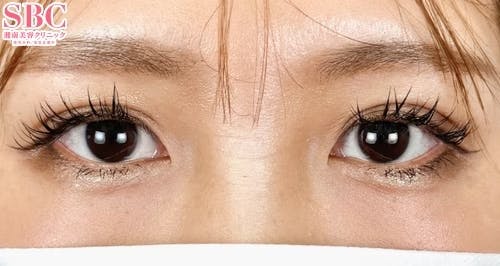 【女性・目元】クイックコスメティーク・トリプルNeo_after