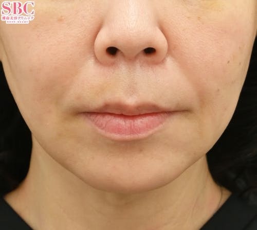 【女性・口元】切らない人中短縮、切らない口角挙上_1week