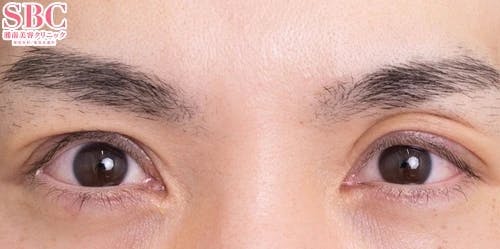 【40代男性・目元】眼瞼下垂＋二重_1week