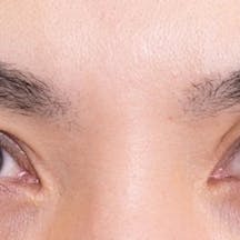 【40代男性・目元】眼瞼下垂+二重_1week