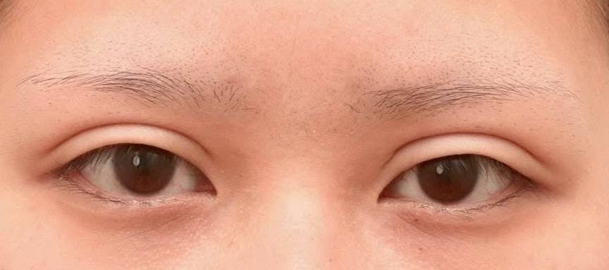 ビアンカ 銀座院(BIANCA)で目の整形：睫毛上皮膚切除（ハム目修正）を受けたゆずぽんさんの写真