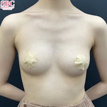 【女性・胸】Motivaエルゴノミックス2(バッグ豊胸)_before