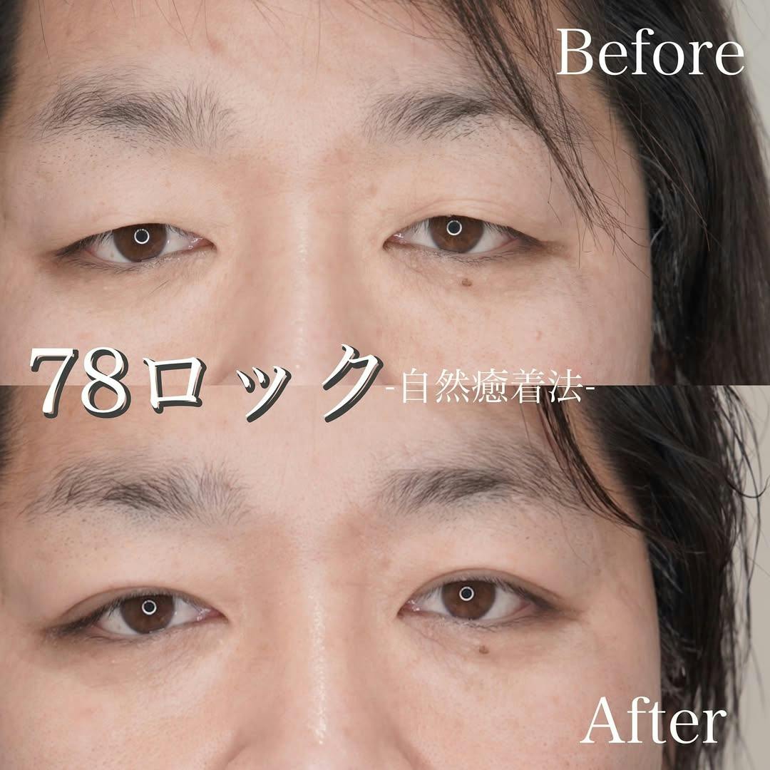 【男性・目元】二重整形（78ロック法）_before_aftar