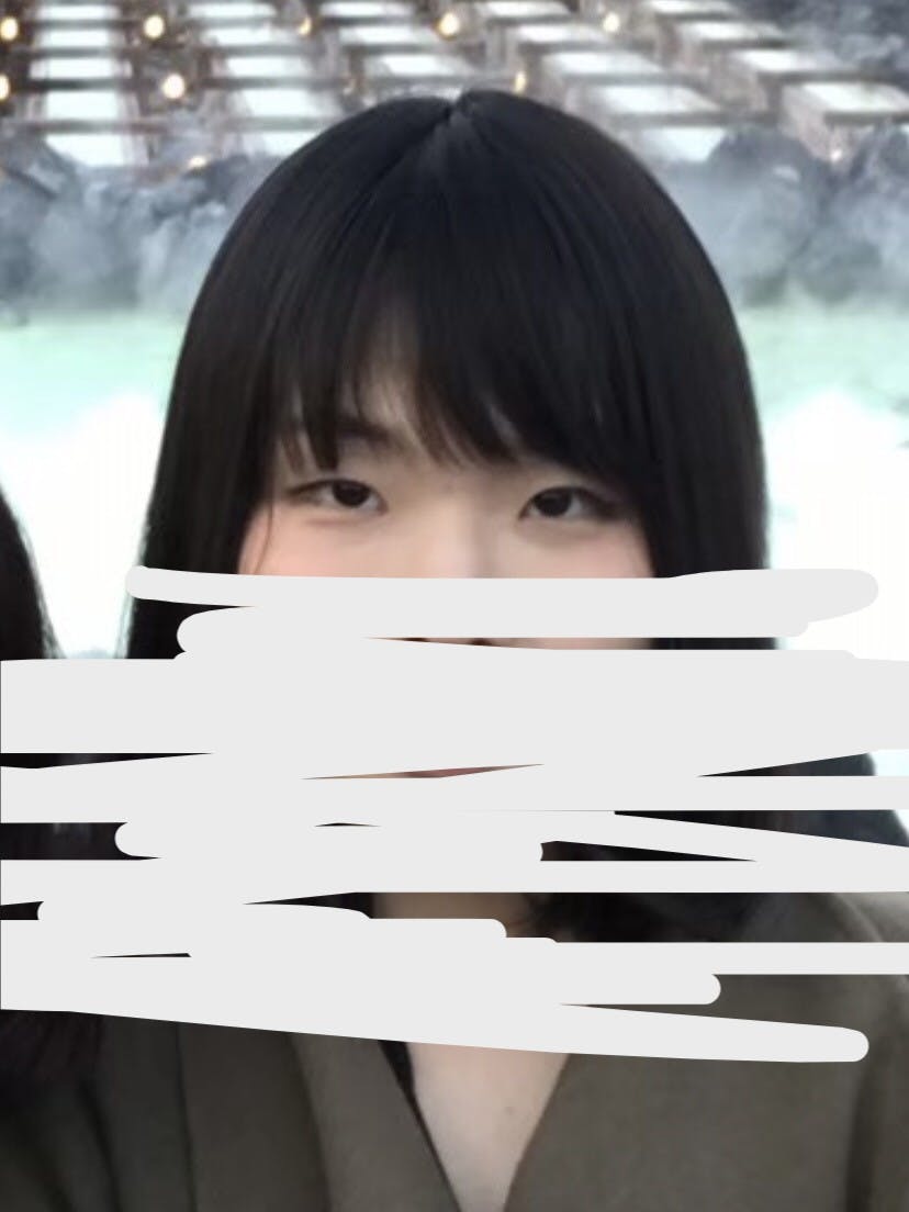 芦屋美容クリニックで切る眼瞼下垂を受けた山藤さんの写真
