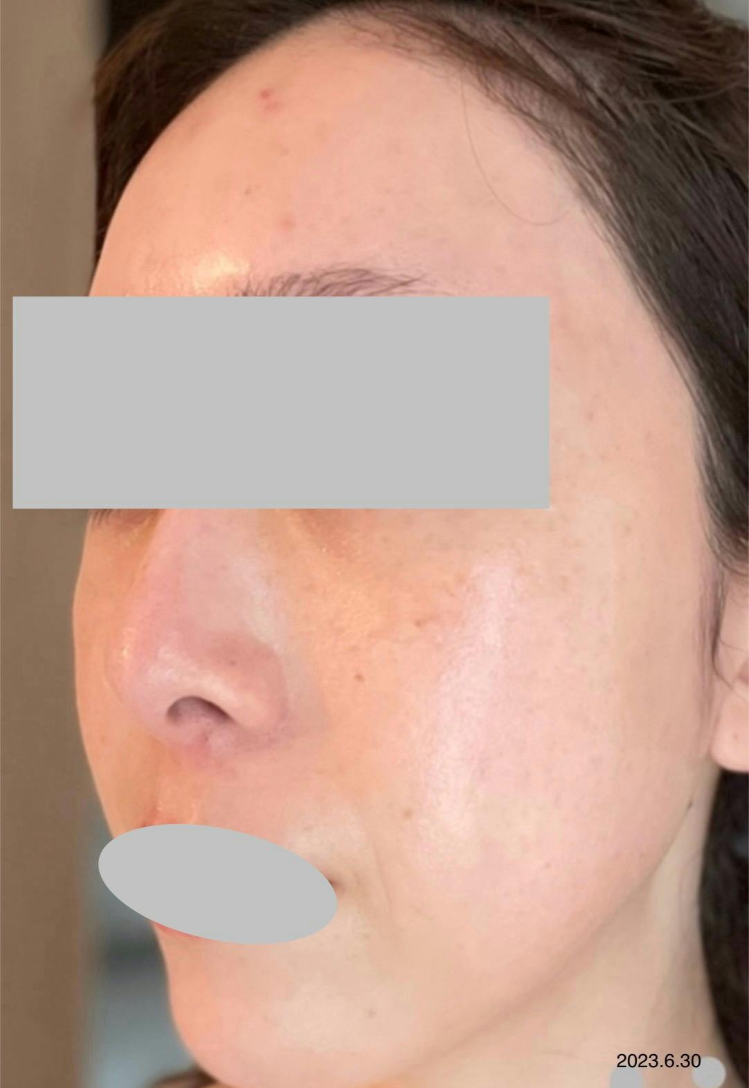 ルラ美容クリニック 渋谷本院でを受けたarai03さんの写真