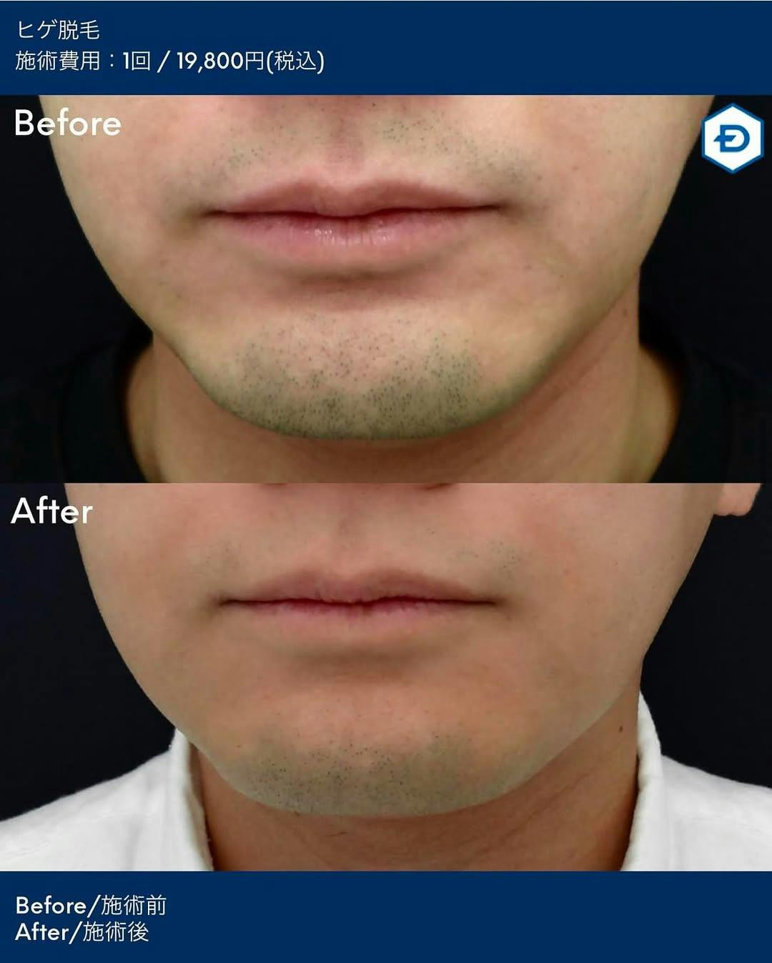 【男性・髭】ヒゲ脱毛_before_aftar