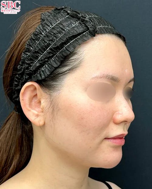 【30代女性・顔】Aquicell(アキーセル)脂肪吸引・ジョールファット除去術・エンブレイスRF_before