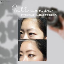 【女性・目元】クマ取りフルコース+額こめかみ脂肪注入_before_aftar