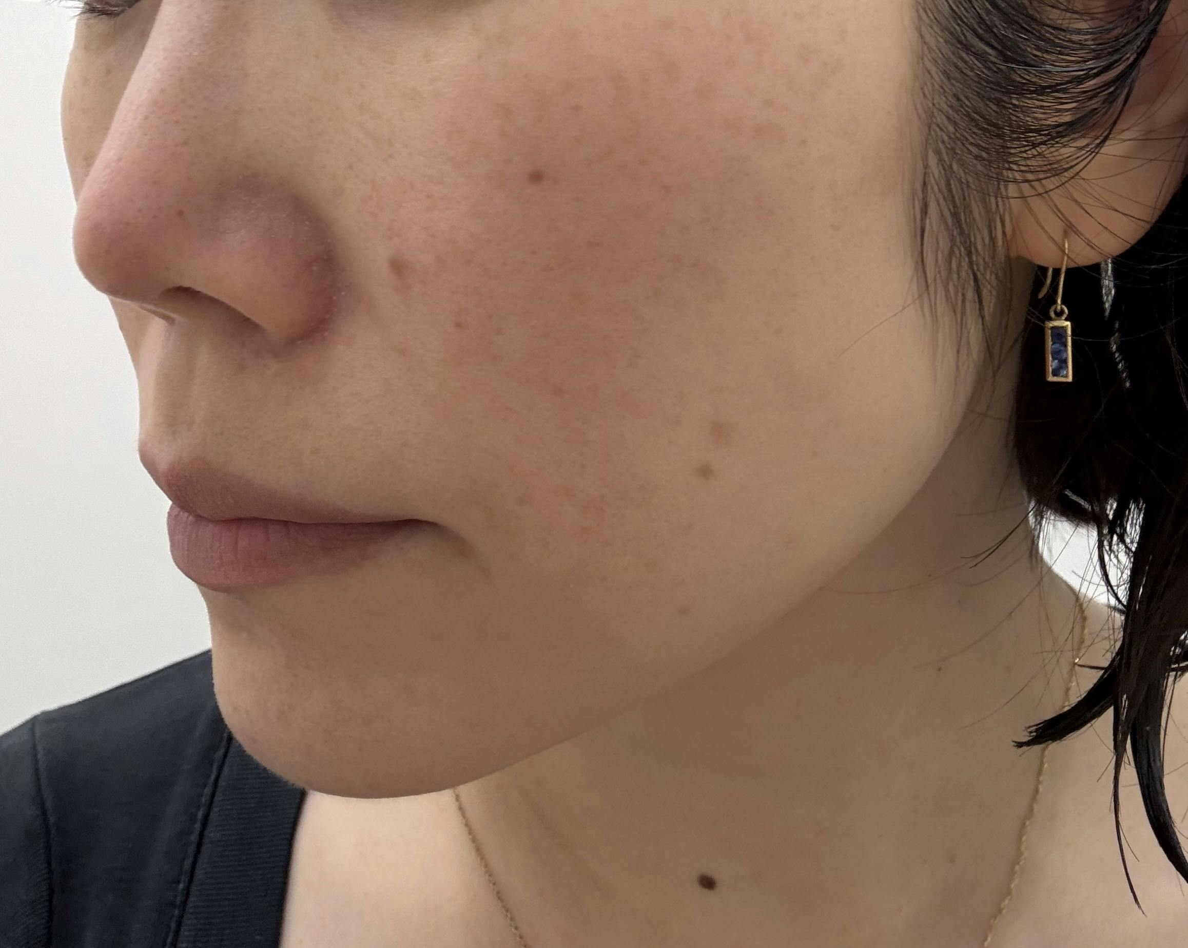 ルラ美容クリニック 新宿院でルメッカを受けたあっこさんの写真