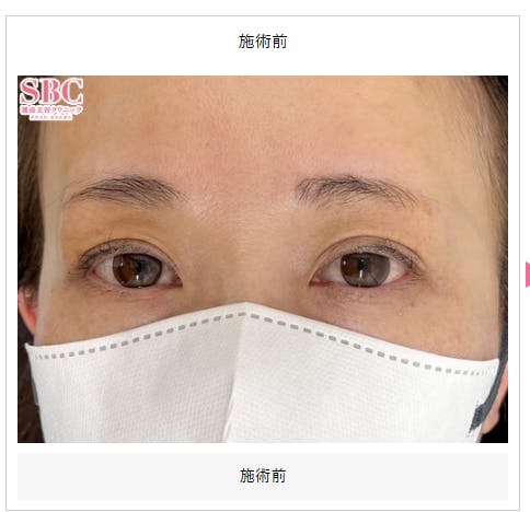 【女性・眉】眉毛アートメイク mocci_before