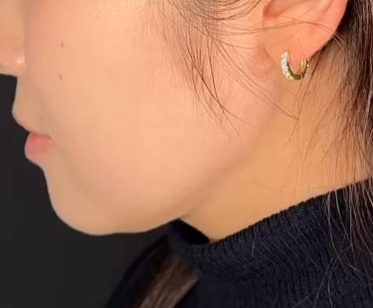 TCB東京中央美容外科 新宿東口院で顔の脂肪吸引：TCB式小顔脂肪吸引注射（頬・顎下）を受けたムームーさんの写真
