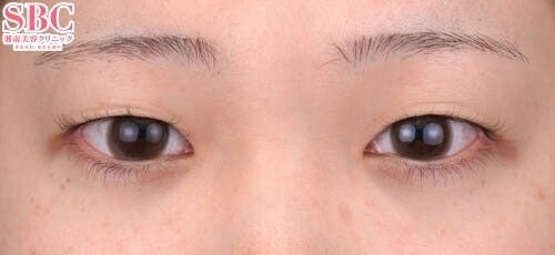 【20代女性・目元】クイックコスメティーク・トリプルNeo_before