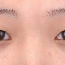 【20代女性・目元】クイックコスメティーク・トリプルNeo_before