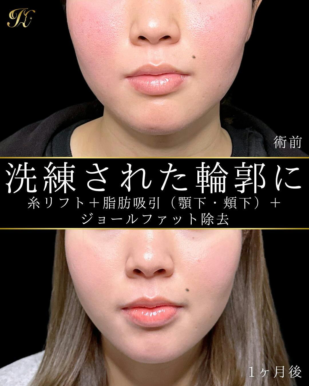【女性・顔・輪郭】糸リフト・脂肪吸引(頬下・顎下)・ジョールファット除去_before_aftar
