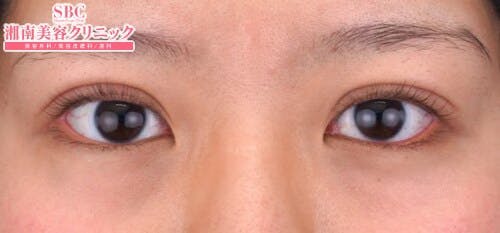 【20代女性・目元】クイックコスメティーク・ダブルNeo_1week