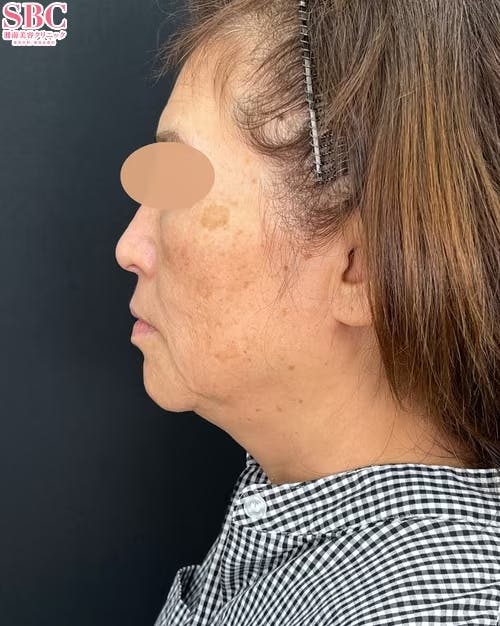 【女性・輪郭】根こそぎVASER脂肪吸引_before