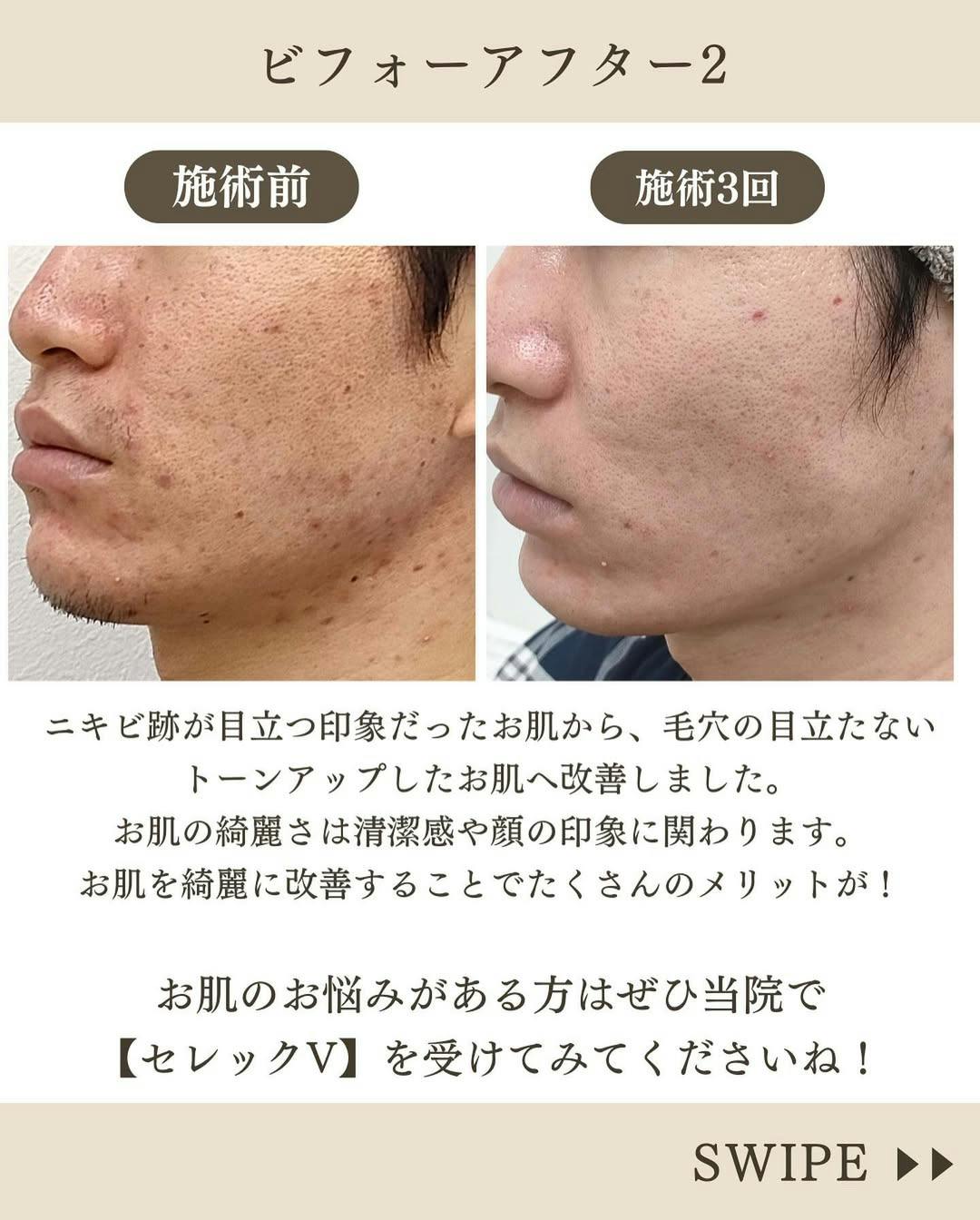 【男性・ニキビ跡】IPL光治療セレックV_before_aftar