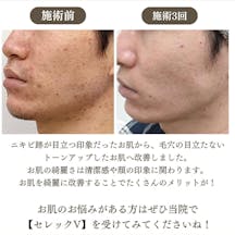 【男性・ニキビ跡】IPL光治療セレックV_before_aftar