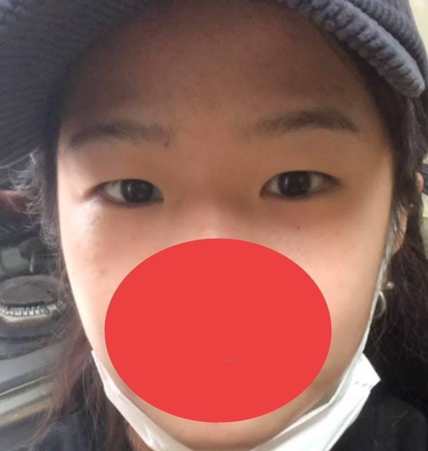 TCB東京中央美容外科 心斎橋院で二重埋没:1dayクイックアイ プレミアムエタニティを受けたみきTさんの写真