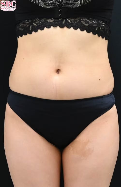 【女性・腹部】ライポマティック脂肪吸引_before