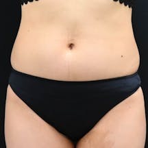 【女性・腹部】ライポマティック脂肪吸引_before