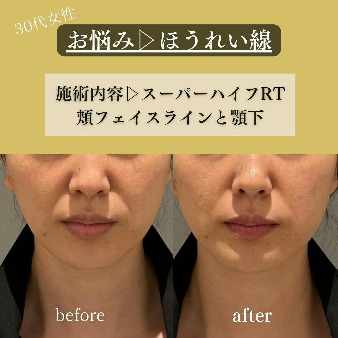【30代女性・ほうれい線】スーパーハイフRT_before_aftar