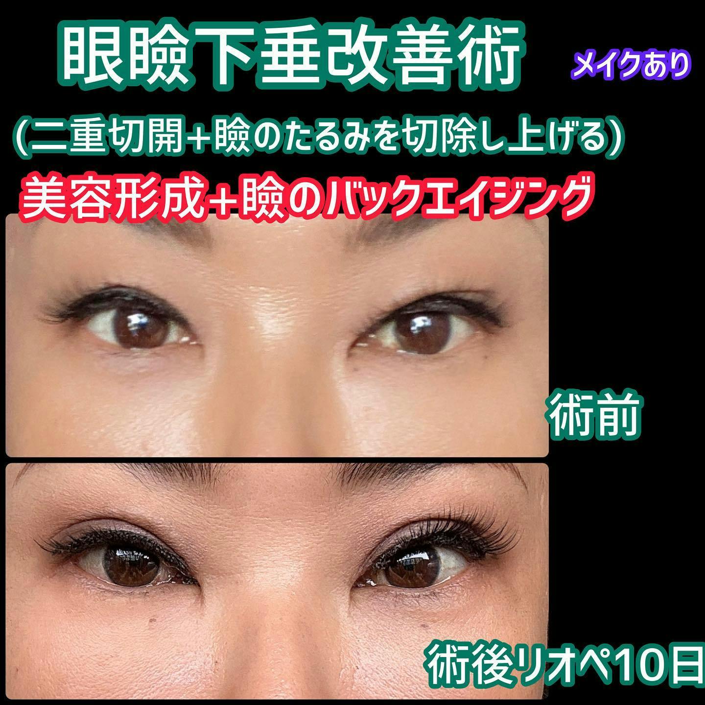 【女性・目元】眼瞼下垂改善術（二重切開+瞼のたるみを切除し上げる）_before_aftar