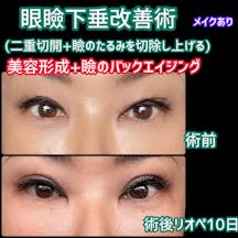 【女性・目元】眼瞼下垂改善術(二重切開+瞼のたるみを切除し上げる)_before_aftar