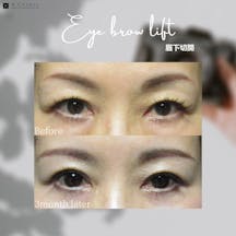 【女性・目元】眉下切開_before_aftar