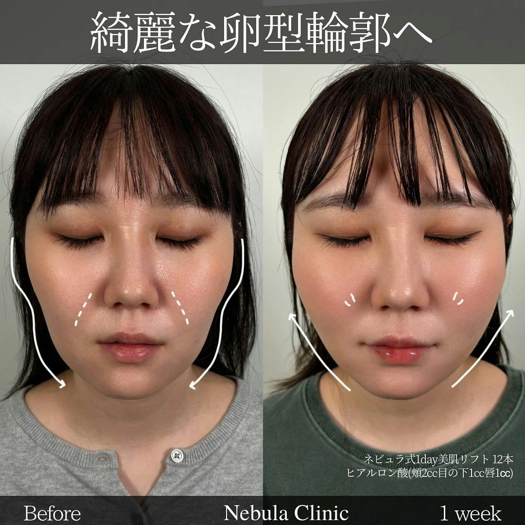 【女性・顔・頬・目の下・唇】糸リフト、ヒアルロン酸注入(頬・目の下・唇)_before_aftar