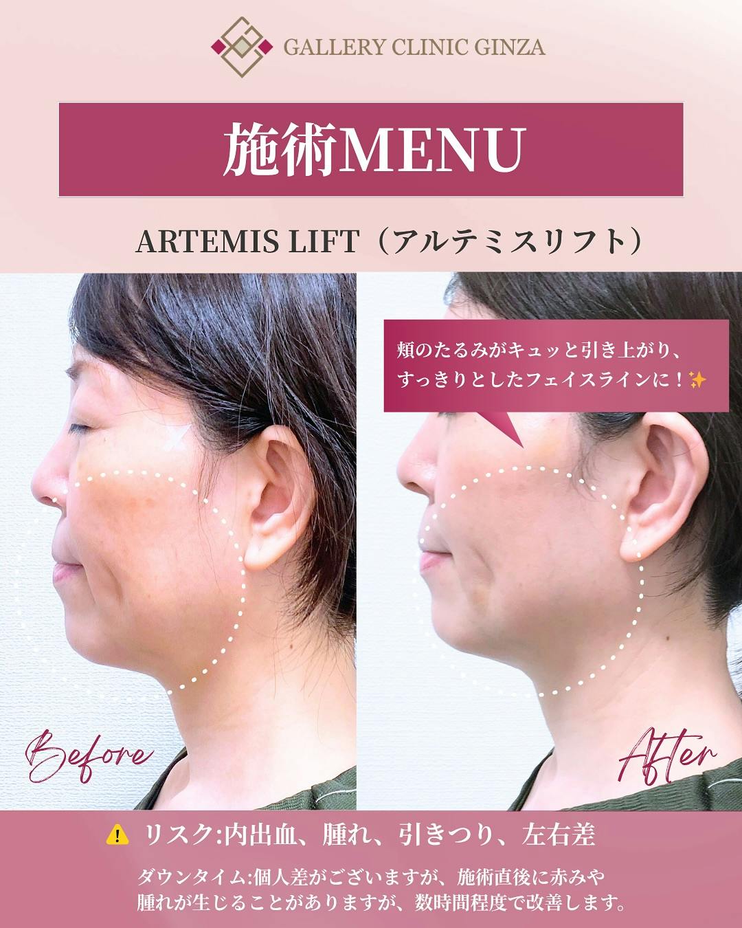 【女性・輪郭】アルテミスリフト_before_aftar