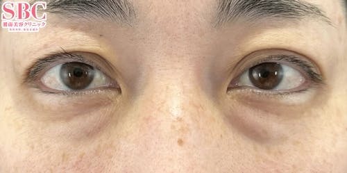 【40代女性・目元】目の下の切らないクマ・たるみ（ふくらみ）取り、ナチュラル脂肪注射ナノリッチ、ナチュラル脂肪注射コンデンスリッチ_before