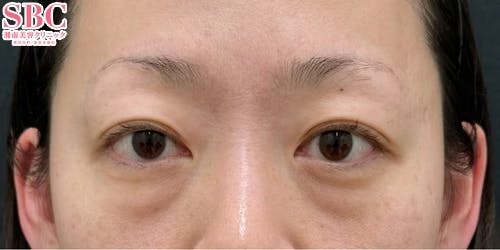 【女性・目元】目の下の切らないクマ・たるみ（ふくらみ）取り ナチュラル脂肪注射コンデンスリッチ ナチュラル脂肪注射ナノリッチ_before