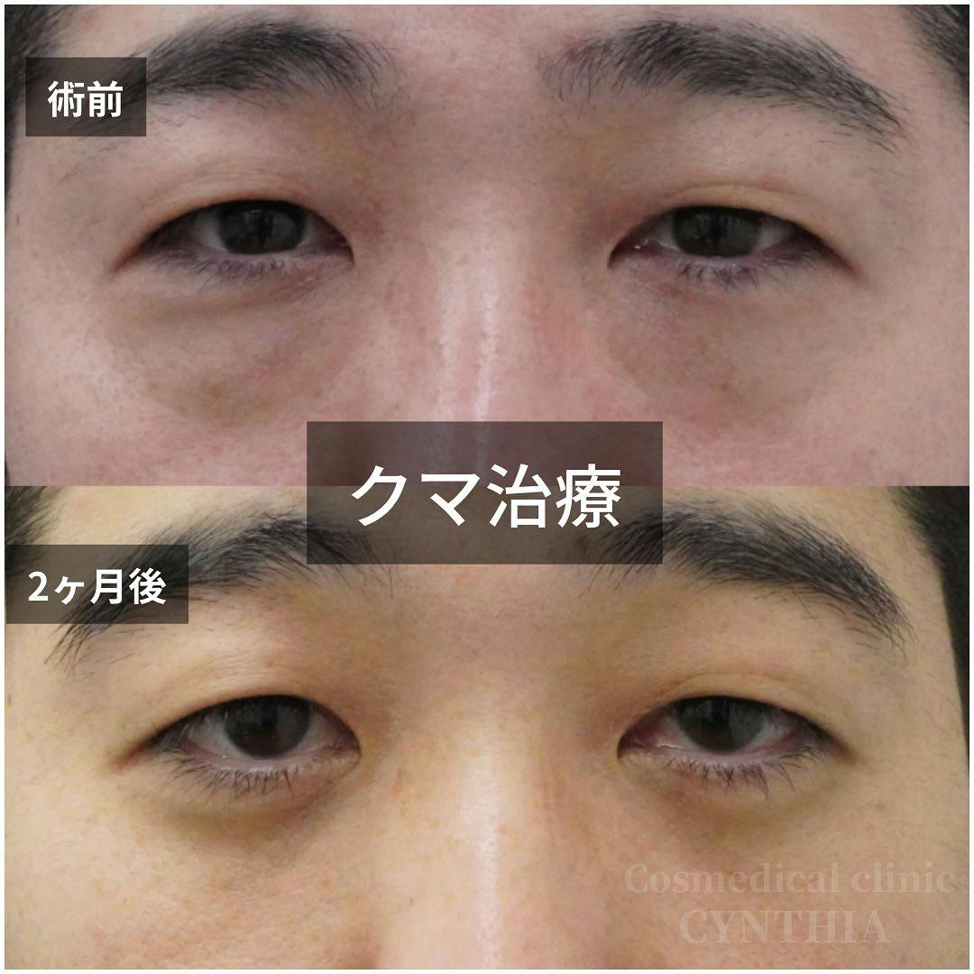 【35歳男性・目元】目の下のクマ取り_before_aftar