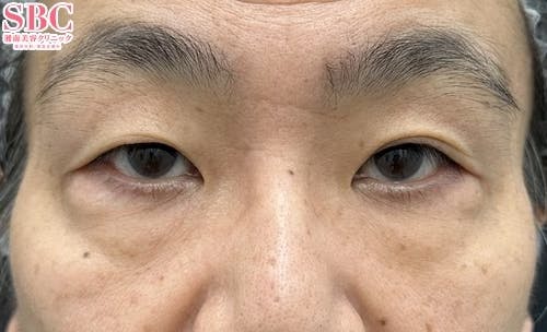 【50代男性・目元】眼瞼下垂＋二重・目の下の切らないクマ・たるみ（ふくらみ）取り_before