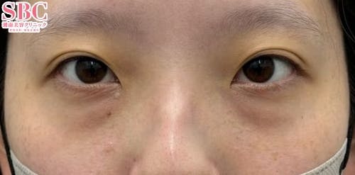 【女性・目の下】ナチュラル脂肪注射コンデンスリッチ、ナチュラル脂肪注射ナノリッチ、目の下の切らないクマ・たるみ（ふくらみ）取り_before