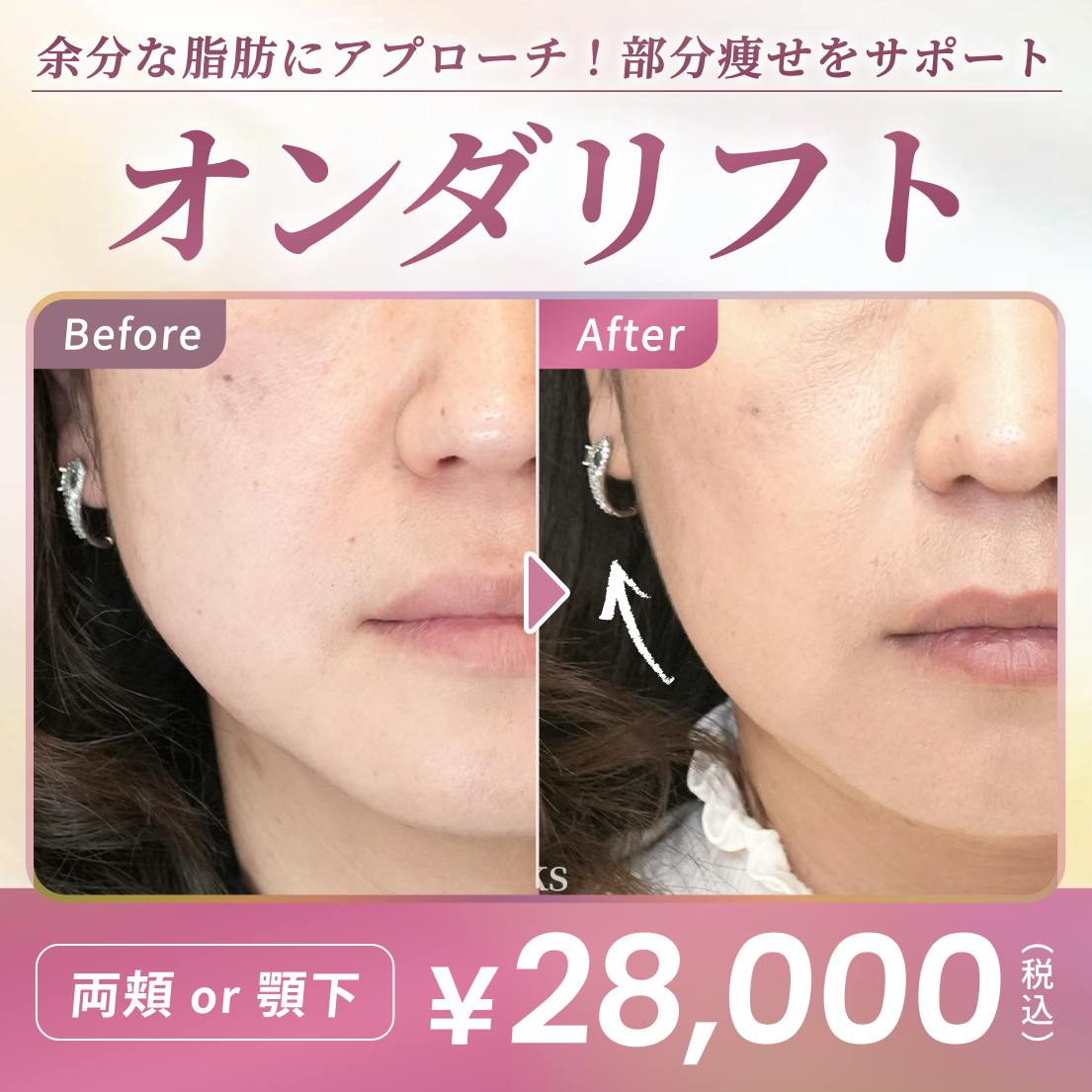 ❣️キレイレポおすすめ❣️ オンダリフト | 気になる脂肪を溶かしてボリュームダウン🫧のサムネイル