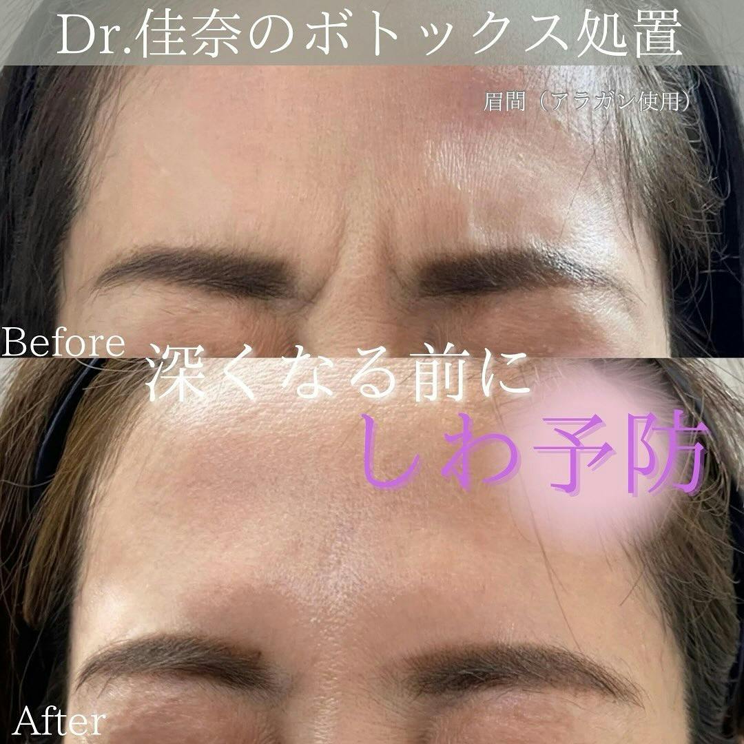眉間ボトックス注射ができる美容クリニックの症例写真・ビフォーアフター・経過写真一覧, image size:1080x1080