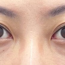 【女性・目元】目の下の切らないクマ・たるみ(ふくらみ)取り、ナチュラル脂肪注射コンデンスリッチ_before