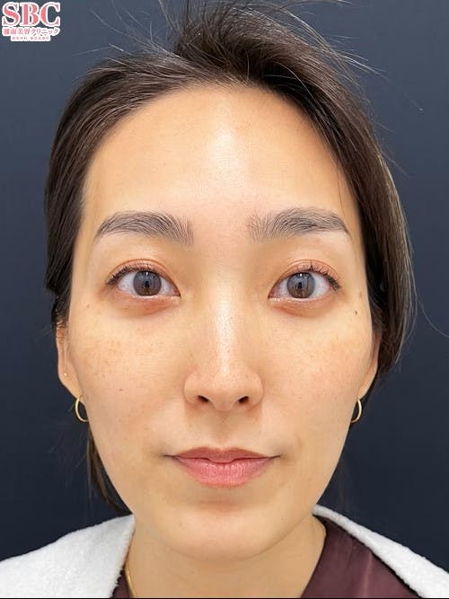 【女性・目元】裏ハムラ法 VOV（ボブ）リフト_aftar