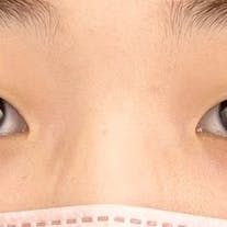 【20代女性・目元】線留めクロス二重術、自然癒着法_before