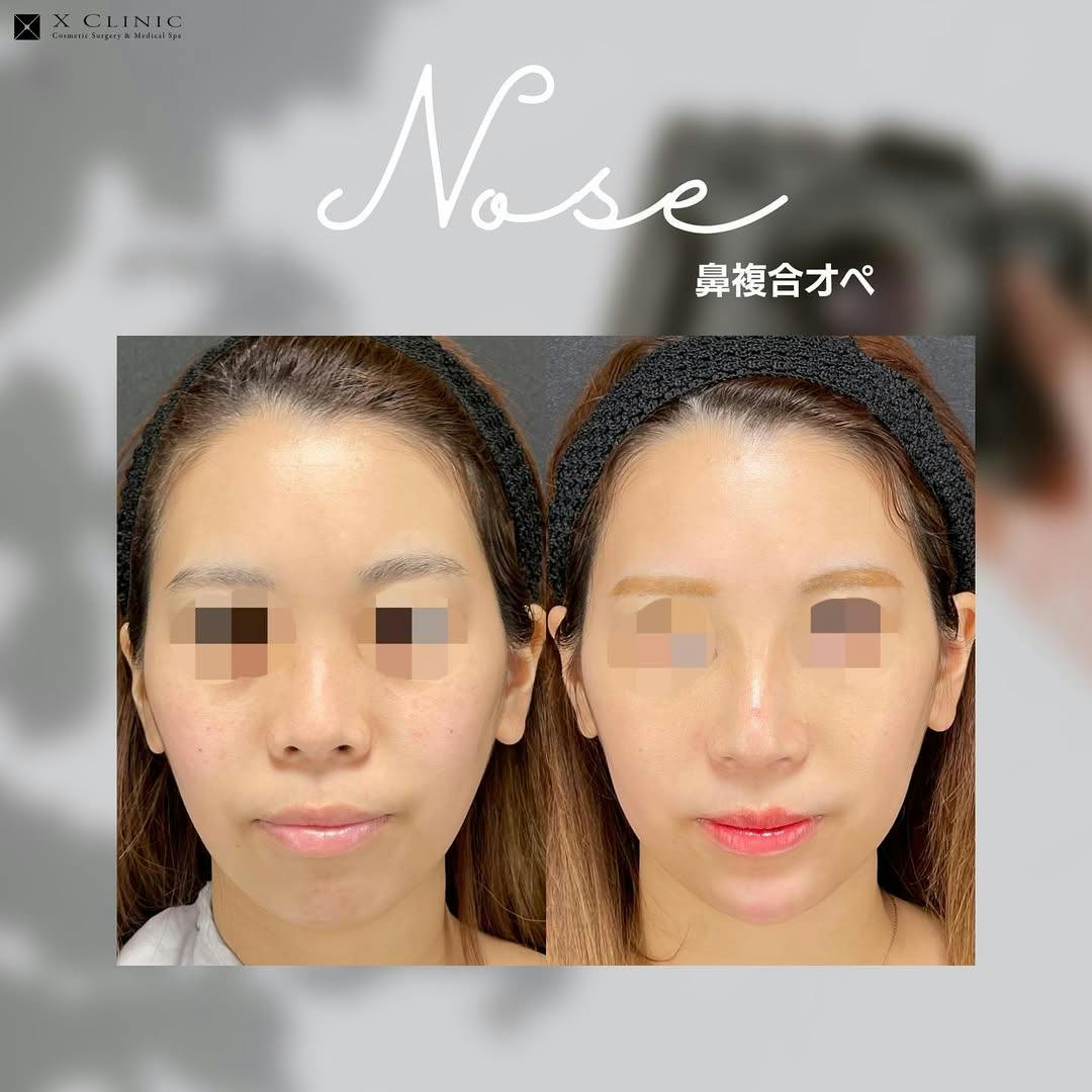 【女性・鼻】鼻複合オペ_before_aftar