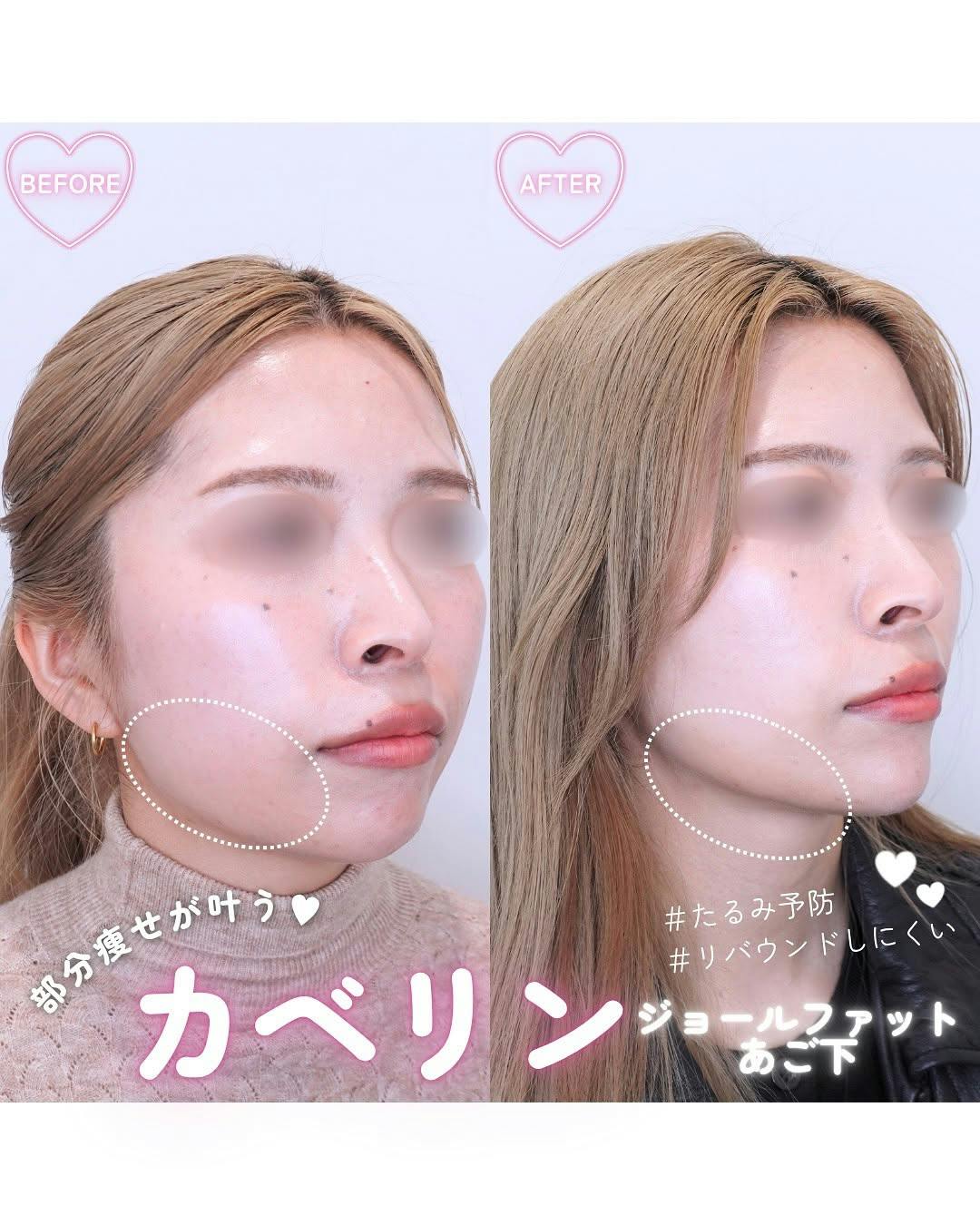 【女性・顔】カベリン ジョールファット・あご下_before_aftar