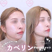 【女性・顔】カベリン ジョールファット・あご下_before_aftar
